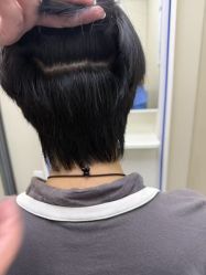 -大麦微针植发全国连锁