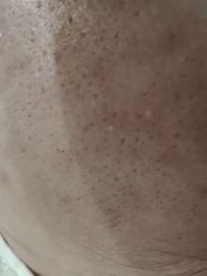 -苗方清颜祛痘·皮肤管理