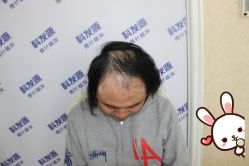 -大麦微针植发丨全国连锁