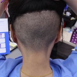 -大麦微针植发丨全国连锁