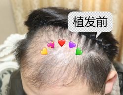 -大麦微针植发全国连锁