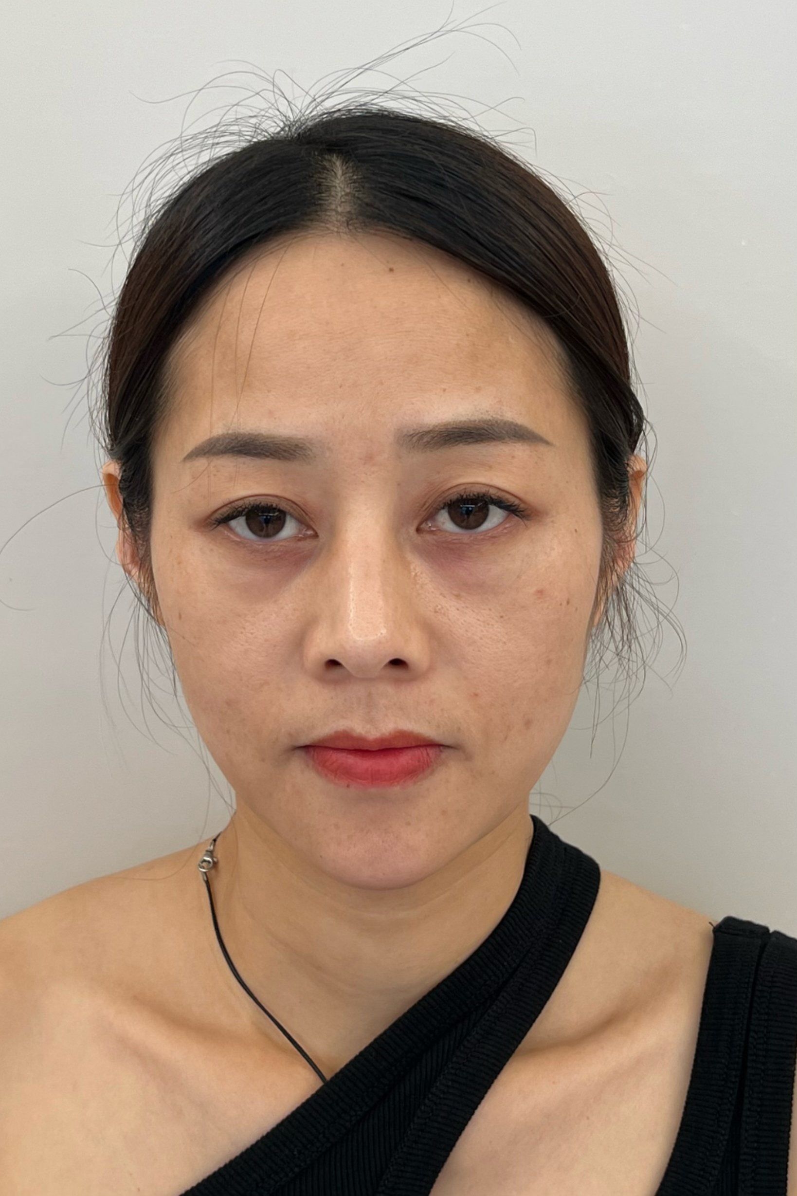 【玻尿酸】幼态脸体验全过程