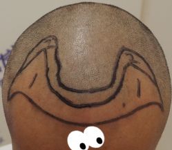 -大麦微针植发全国连锁