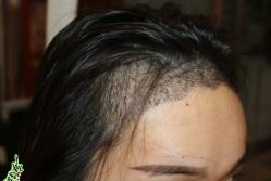 -大麦微针植发丨全国连锁