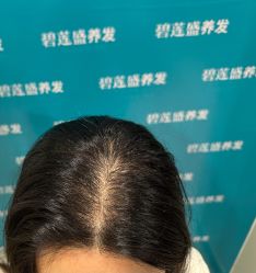 -碧莲盛·不剃发植发