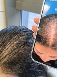 -碧莲盛·不剃发植发