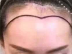 体验前-熙朵美学植发·连锁品牌