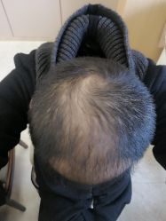 点击看大图 -大麦微针植发丨全国连锁