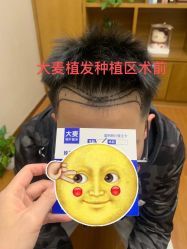 -大麦微针植发全国连锁