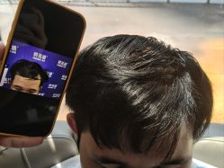 -碧莲盛·不剃发植发