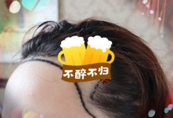 -大麦微针植发全国连锁