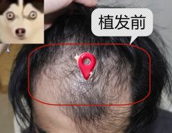 -大麦微针植发全国连锁
