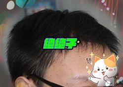 -大麦微针植发全国连锁