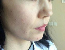 -爱莎扁平疣·汗管瘤·斑痣中心