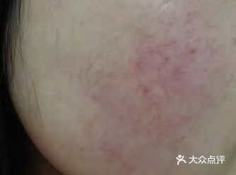 敏感肌的五个特征，你符合几个？
