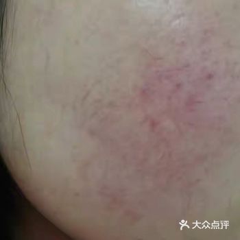 敏感肌的五个特征，你符合几个？