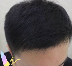 -大麦微针植发丨全国连锁