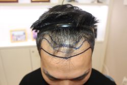 -大麦微针植发丨全国连锁