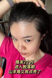 -碧莲盛·不剃发植发