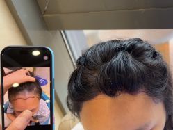 点击看大图 -碧莲盛·不剃发植发