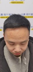 体验后-大麦微针植发丨全国连锁