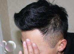 -大麦微针植发丨全国连锁