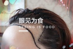 -大麦微针植发全国连锁