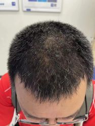 -大麦微针植发全国连锁