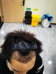 -碧莲盛·不剃发植发