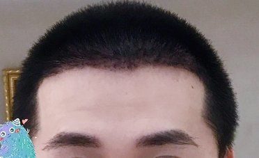 -大麦微针植发丨全国连锁