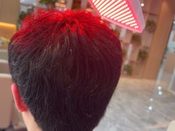 -碧莲盛·不剃发植发