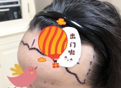 -大麦微针植发全国连锁