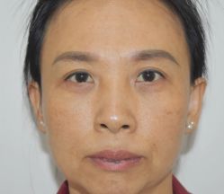 体验后-广州健丽·去眼袋医疗美容机构