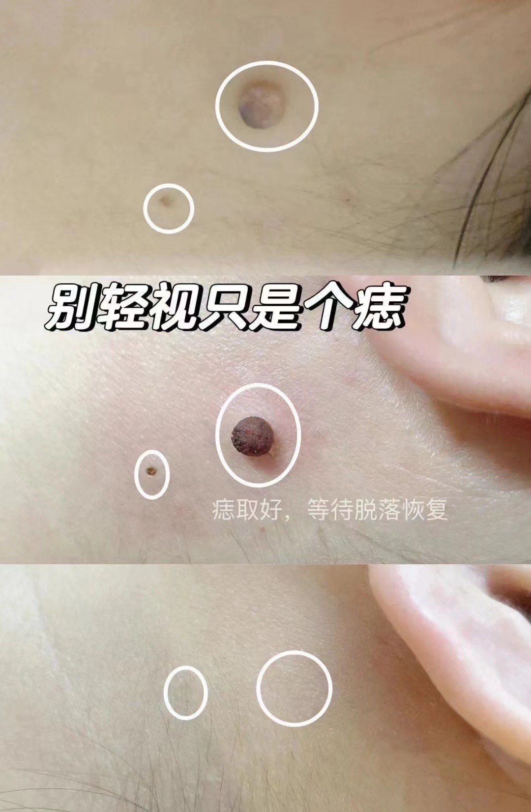 别轻视只是个 痣 
整体完美脱落,秘