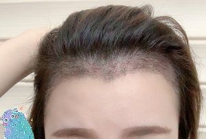 -大麦微针植发丨全国连锁