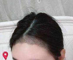 -大麦微针植发丨全国连锁