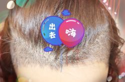 -大麦微针植发全国连锁