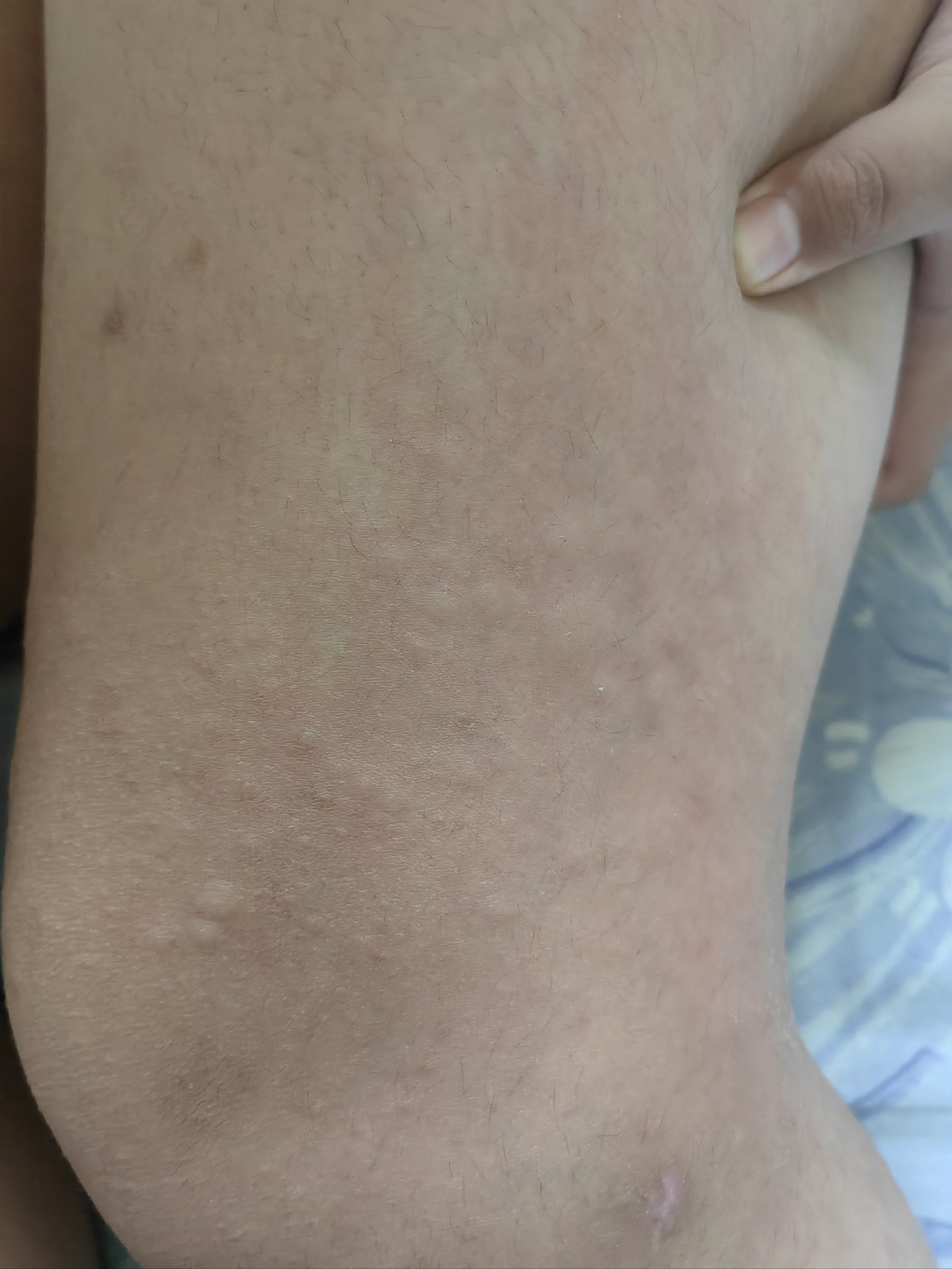 昨天玩了一天,今天早上起床孩子腿过敏起疹