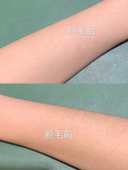 -HEYAN荷妍专业脱毛连锁机构