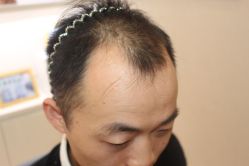 -大麦微针植发丨全国连锁