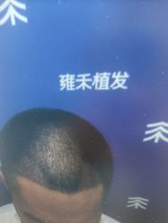 -雍禾植发全国连锁