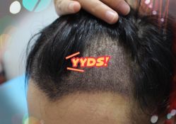 -大麦微针植发全国连锁