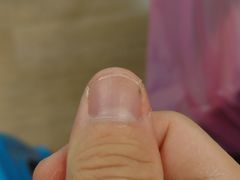 -Andrew指甲专科灰指甲·甲沟炎矫正·3D步态矫形鞋垫定制(上海法华镇路旗舰店)