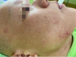 -苗医生草本科技祛痘