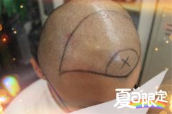 -大麦微针植发全国连锁