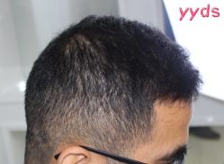 -大麦微针植发丨全国连锁