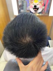 -大麦微针植发丨全国连锁