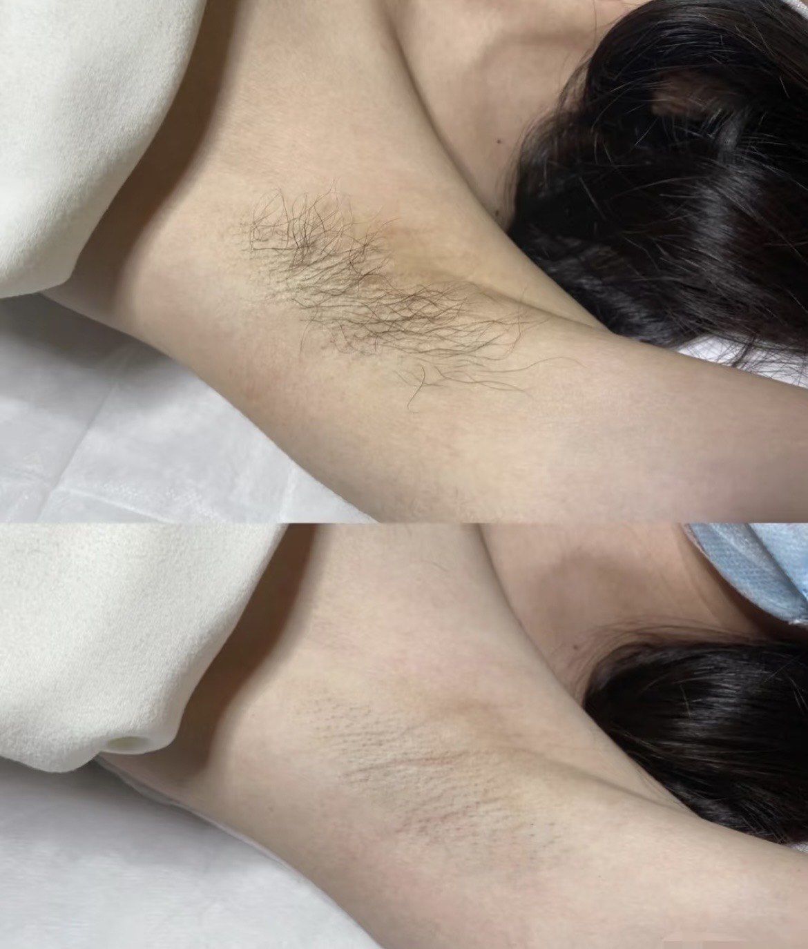 腋下脱毛
