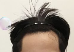 -大麦微针植发全国连锁