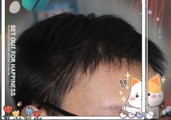 -大麦微针植发全国连锁